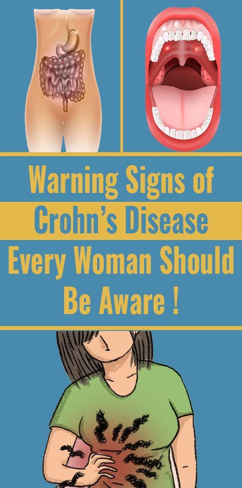 Warning Signs Of Crohns Disease Every Woman Should Know Crohns
