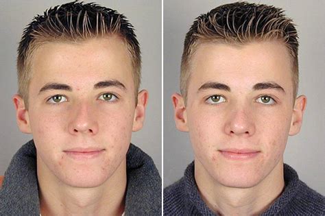 Find your solution related to nose surgery before and after , get your query answered 24*7 with expert advice and tips from doctors on lybrate. Male Rhinoplasty Patient 1 - Parker Center for Plastic Surgery