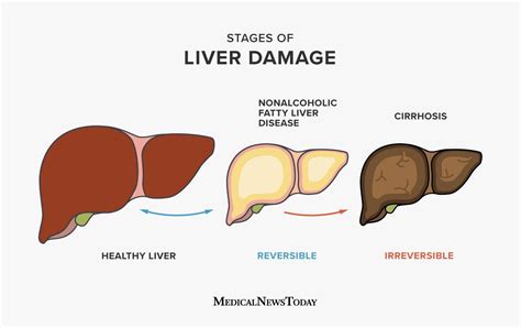 Fatty Liver Disease Symptoms Causes Risks And Treatment