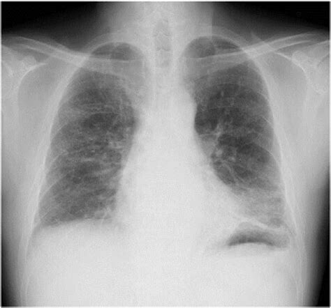 Chest X Ray Image In 2016 Showing Ground Glass Opacities Ggo And
