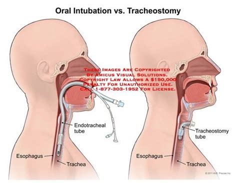 Endotracheal Tube Inserted Through The Nares Or The Mouth Past The