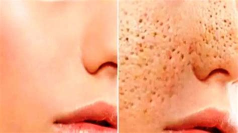 3 Days And All Open Pores Will Disappear From Your Skin Forever Zinta