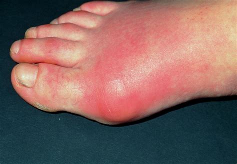Inflamed Toe Joint In Patient With Gout Photograph By Dr P Marazzi