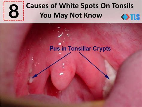 White Bump On Tonsil Renew Physical Therapy