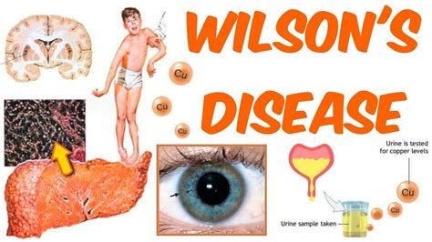 Wilsons Disease Wilsons Disease Disease Hereditary Diseases