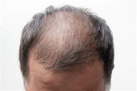 Nutrients such as zinc, iron, niacin, selenium, fatty acids, folic acid, biotin, amino acids, protein, antioxidants, and vitamins d, a, and e, can all affect hair growth, says nutritionist and. Hair Loss Causes: Can Too Much Vitamin A Cause Balding ...