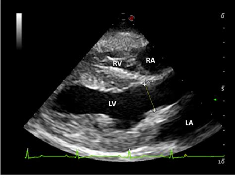 Right Parasternal Long Axis View Of The Left Ventricular Outflow Tract