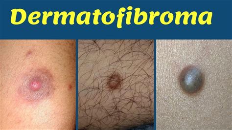 Dermatofibroma Treatment Hard Bump On Leg चमड़ी में सख़्त गाँठ का