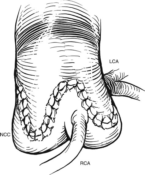 Ventricular Outflow Tract Obstruction In The Adult Thoracic Key