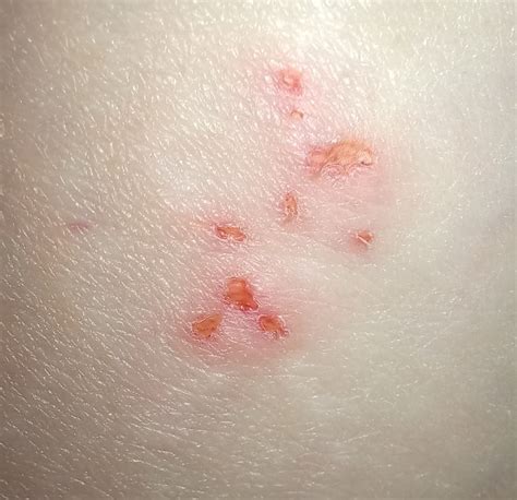 What Is This Weird Rash That Appeared On My Leg Raskdocs