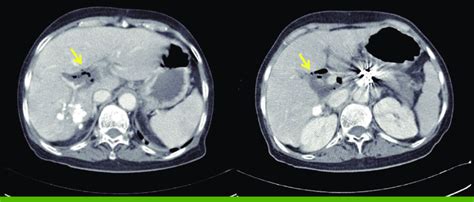 Abdomen Ct Scan Shows Viable Tumor Around Previous Lipiodolized Mass In