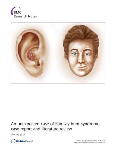 Ramsey Hunt Syndrome Ramsay Hunt Syndrome Facial Nerve Palsy Download