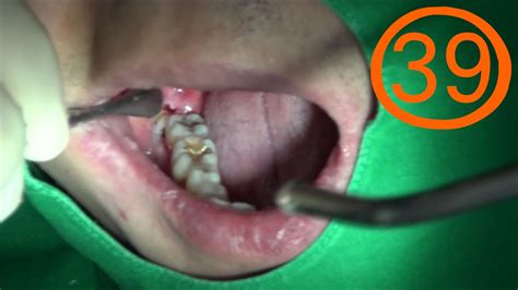 48 Surgical Extraction Of Lower Horizontal Impacted Wisdom Teeth Youtube
