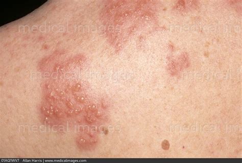 Stock Image Infectious Diseases Shingles Herpes Zoster Clusters Of