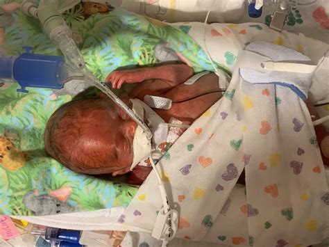 Baby Born 4 Months Premature Finally Heads Home After 1 Year In Nicu