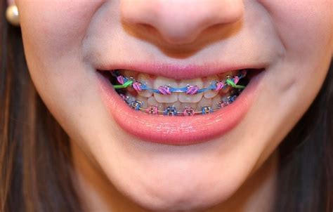 33 best images about braces on pinterest colors pink braces and 7 months
