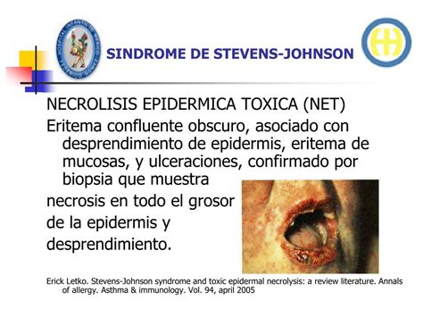 S Ndrome De Stevens Johnson Causas Sintomas Tratamento Complica Es