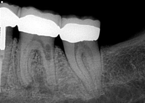 Dental Resorption The Silent Killer Dentistryiq