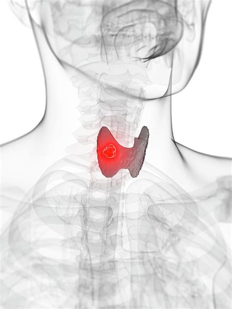 Thyroid Cancer Photograph By Scieproscience Photo Library Fine Art