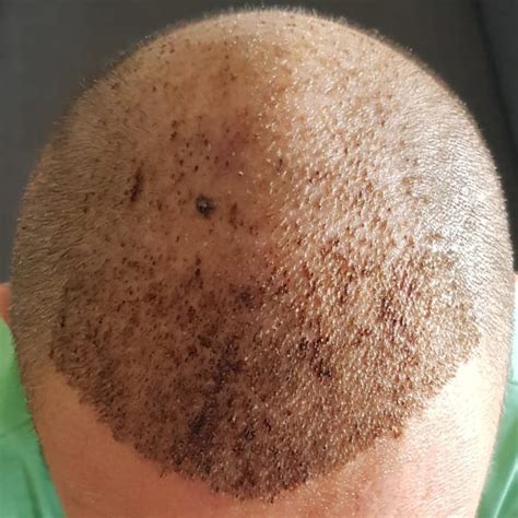 Itching After Hair Transplant The What Why And How Clinicadvisor