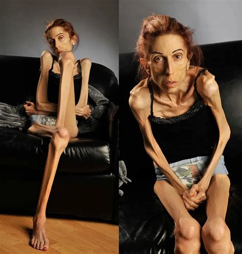¿recuerdas El Peor Caso De Anorexia Del Mundo Dio Un Gran Cambio Y Así Luce En La Actualidad