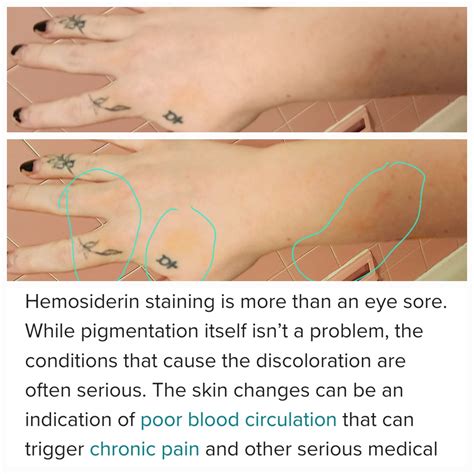 Hemosiderin Staining Anyone Else Rfibromyalgia