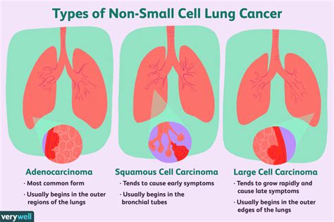 Lungenkrebs im Frühstadium Überblick und mehr