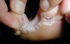 Left untreated, an infection could spread to other toenails, skin, or even your. Malady Of The Month Archives - Athlete's Foot