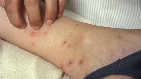 Flea Treatment - PCCI