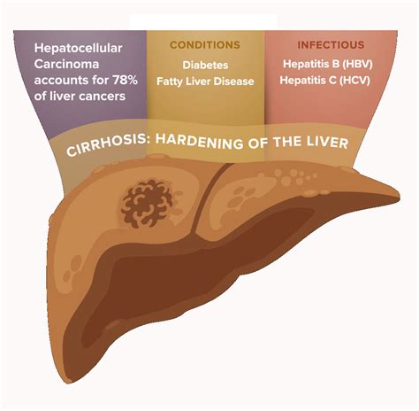 Liver Cancer — Cancer Prevention And Research Institute Of Texas