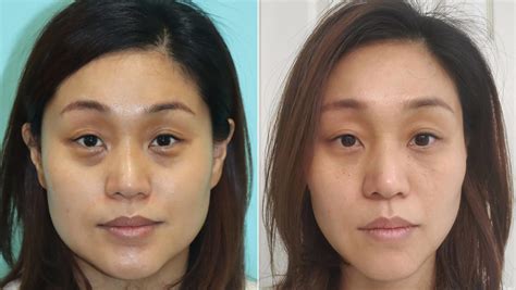 Botox Injections Before And After Photos The Naderi Center For