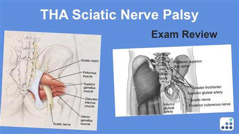 THA Sciatic Nerve Palsy Exam Review Daniel Berry MD YouTube