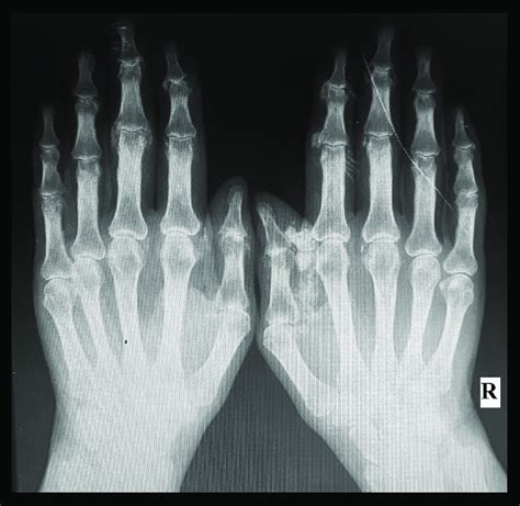 X Ray Of Hands With Erosive Arthritis And Periarticular Calcification