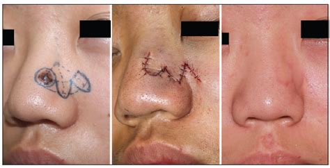 A Modified Bilobed Flap Design For Nasal Tip Defects