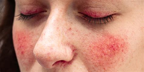 18 Common Rosacea Triggers You Need To Know Curology