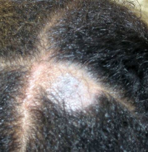Tinea Capitis Scalp Ringworm Causes Symptoms And Treatments