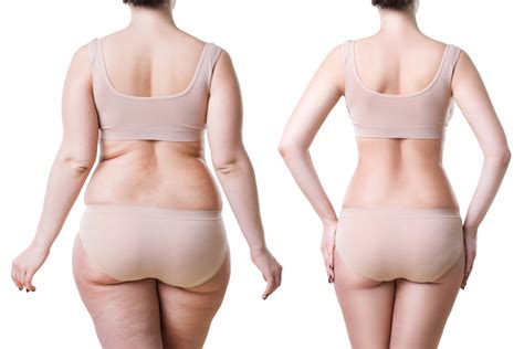 Liposuction Recovery A Week By Week Guide Omaha Liposuction By Imagen