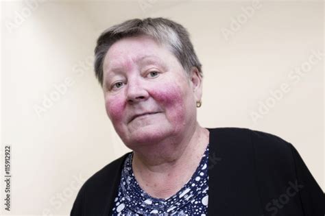 Elderly Woman With Rosacea Facial Skin Disorder Stock Photo And
