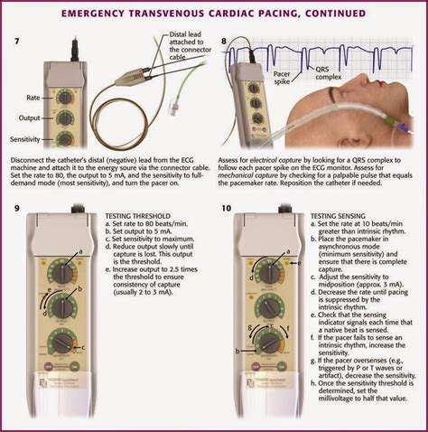Transvenous Pacing — Em Curious