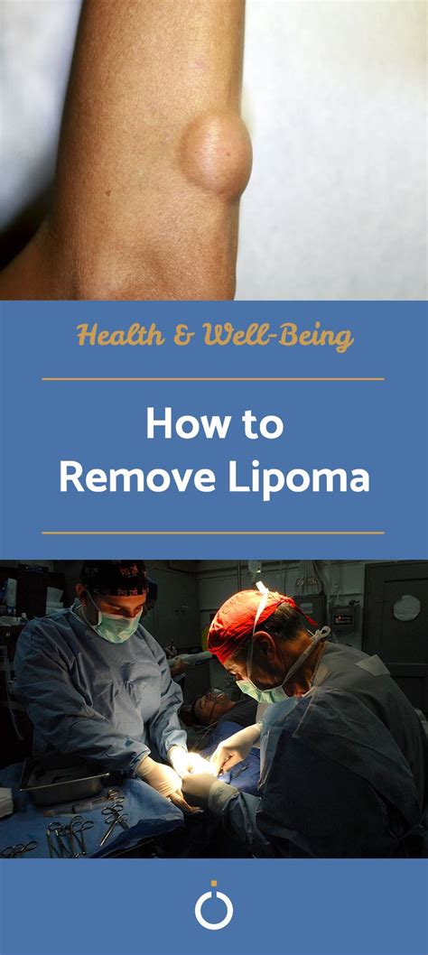 How To Remove Lipoma How To Remove Lipoma Removal Healthy Lifestyle
