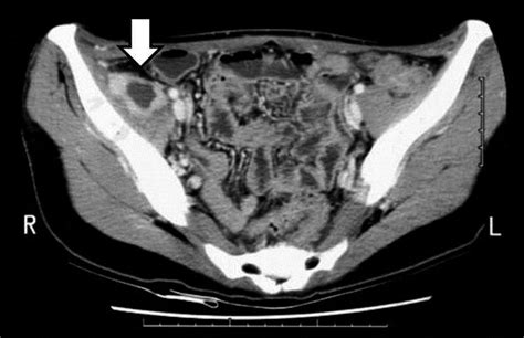 Recurrence Of The Psoas Abscess On Abdominal Computed Tomog Raphy