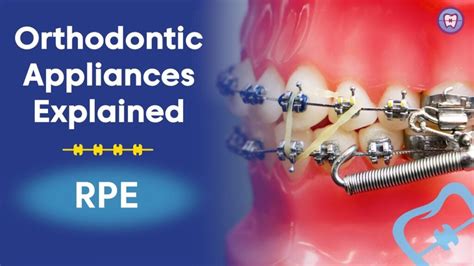 Orthodontic Appliances Explained Rpe Cceta