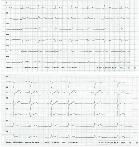 The 12 Lead Electrocardiogram Showing Resolution Of St Elevation In