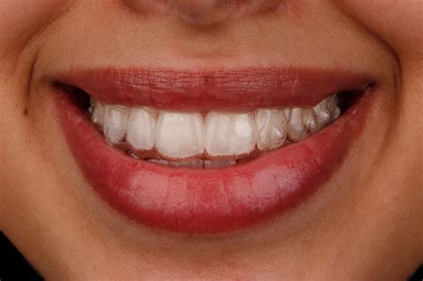 ORTHODONTIC TREATMENT WITH INVISALIGN Is This An Easy Procedure