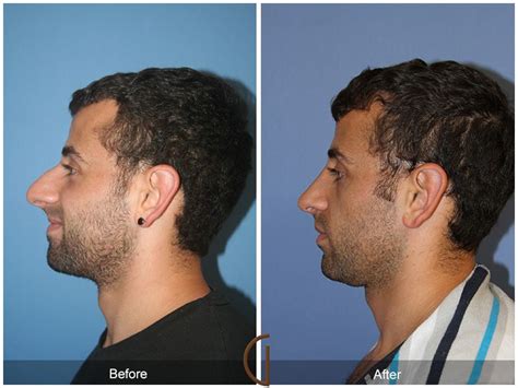 Mens Rhinoplasty Before And After Clokeyroegner 99