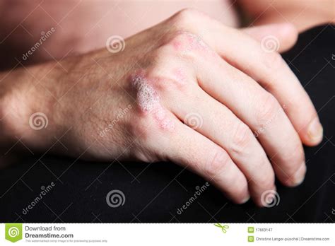 Severe Psoriasis On The Hand Royalty Free Stock Photography Image