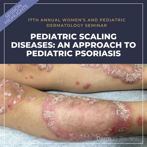 Pediatric Scaling Diseases An Approach To Pediatric Psoriasis Next