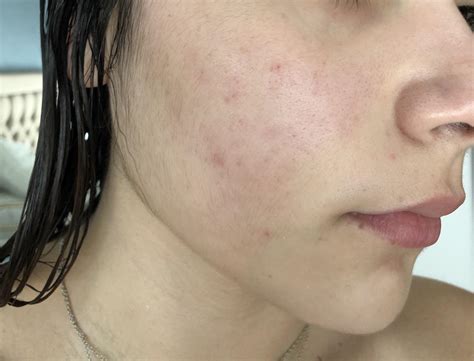 [skin concerns] what to do about these red spots patches left after acne r skincareaddiction