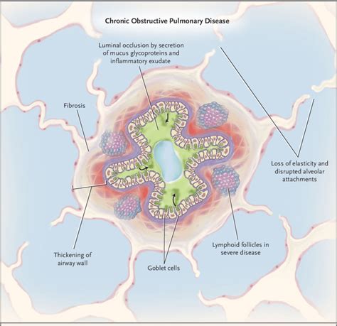 Figure. Small-Airway Obstruction in Chronic Obstructive Pulmonary