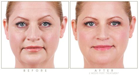 Stronger gels such as the voluma can cost a lot more. Juvederm - CosMedic Laser Clinic